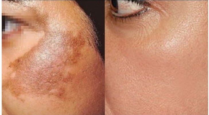 Skin Pigmentation