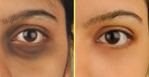 Dark Circles