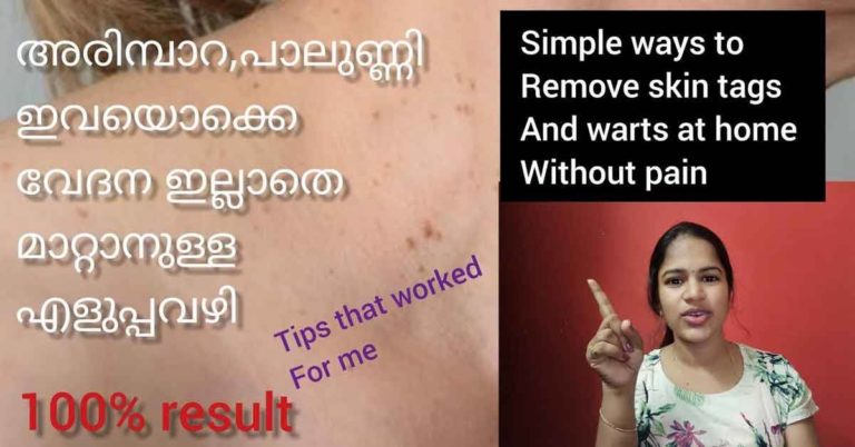 Easy ways to remove skin tags and warts at home