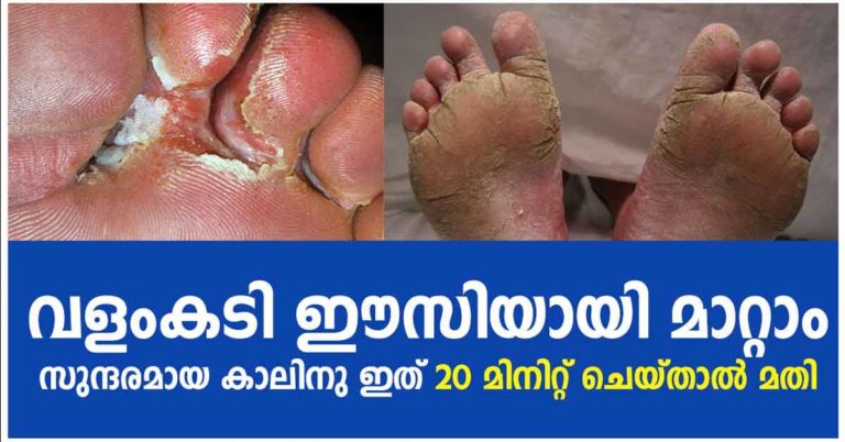 Athlete’s Foot