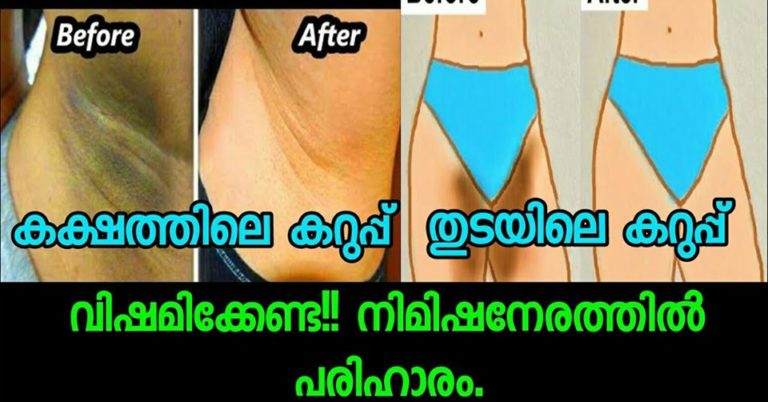 Underarms witening treatment&How to clear dark inner thighs..