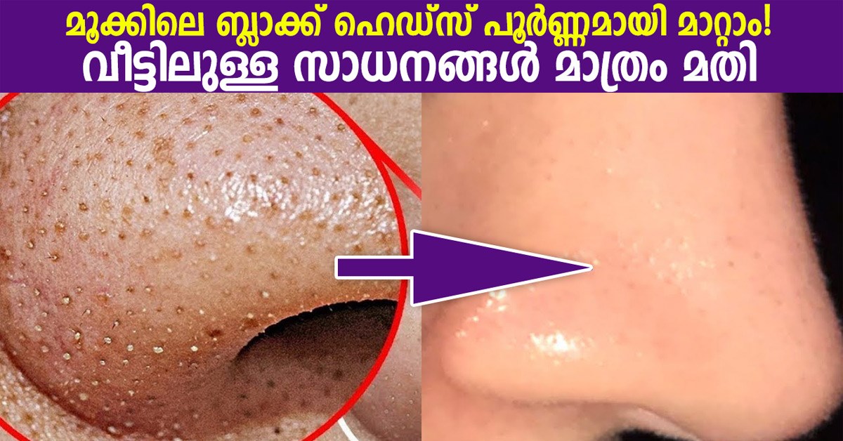 how to remove blackheads on nose at home