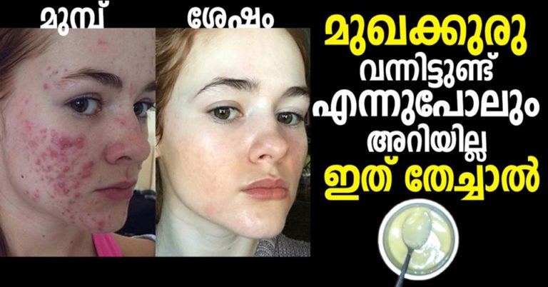 How do you prevent pimples