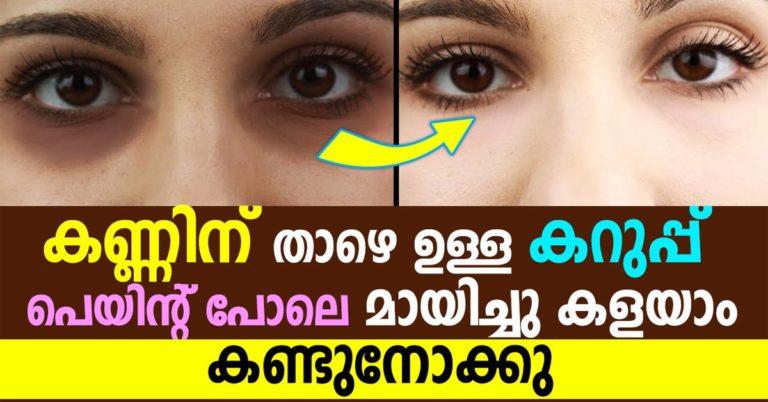 7 Ways to Get Rid of Dark Circles Under Your Eyes