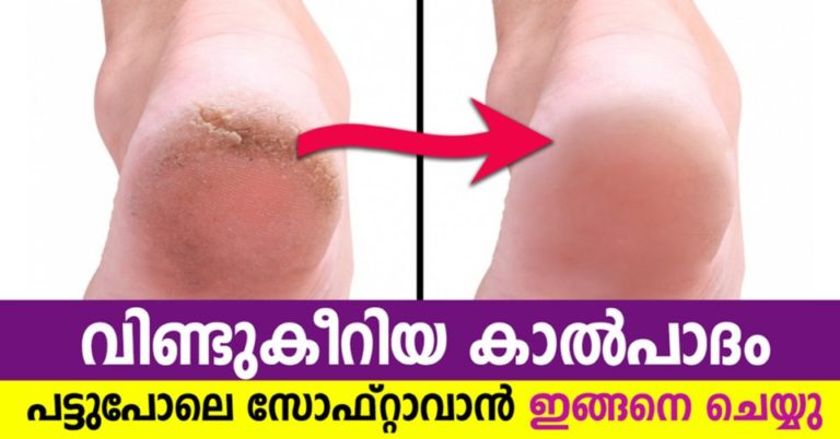 How to Fix Cracked Heels at Home