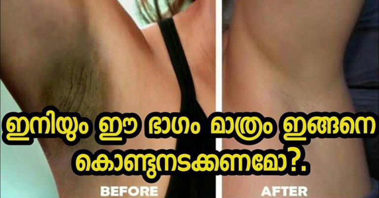 Effective Home Remedies for Dark Underarms