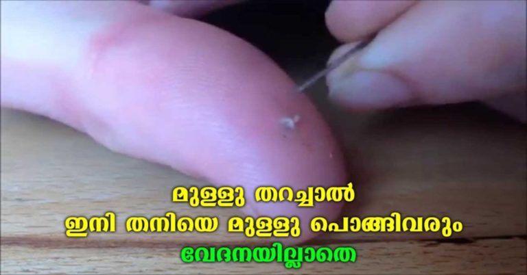 Creative Ways to Remove a Splinter
