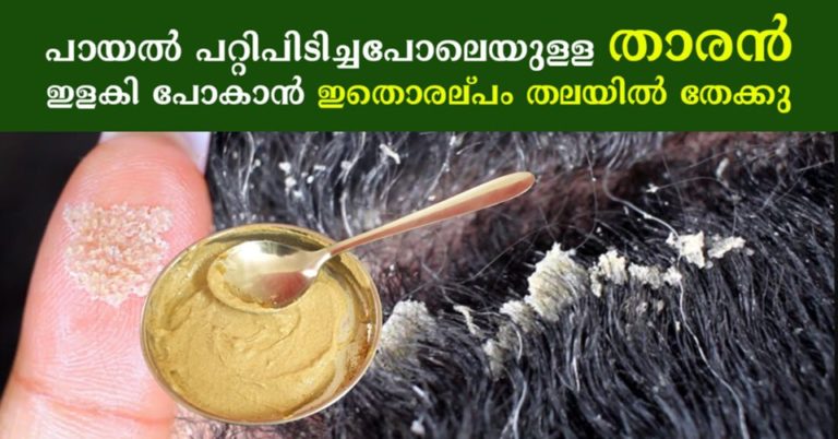 Easy Home Remedies to Get Rid of Dandruff