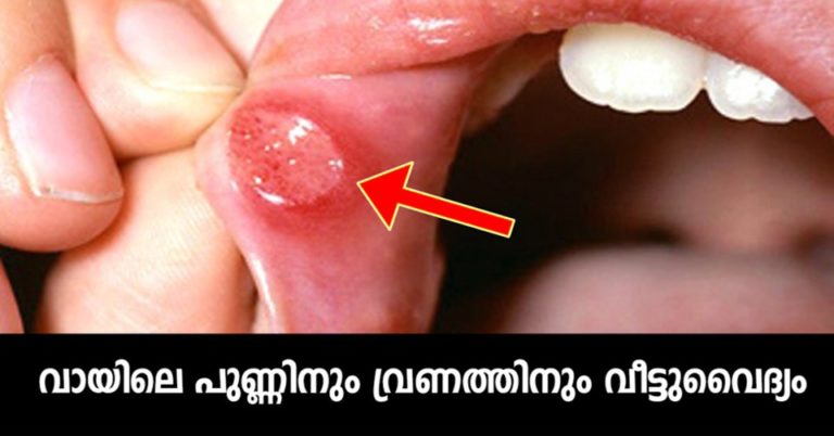 Ways to Get Rid of Canker Sores