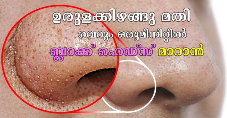 Potatoes are enough to turn blackheads in just a minute