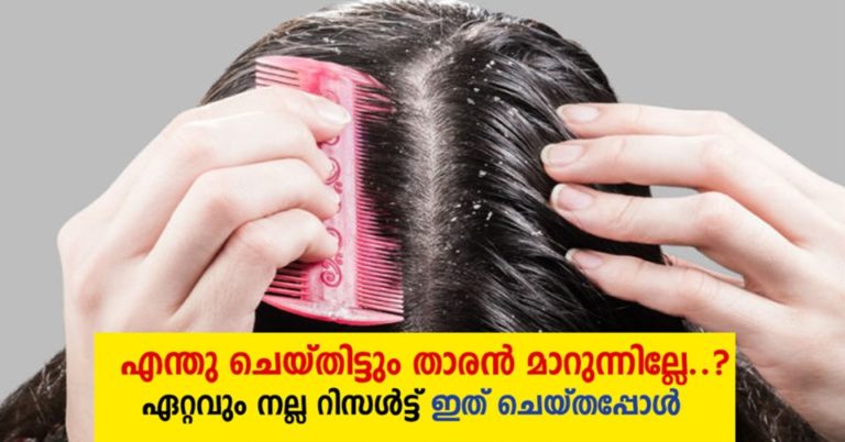 How to get rid of dandruff