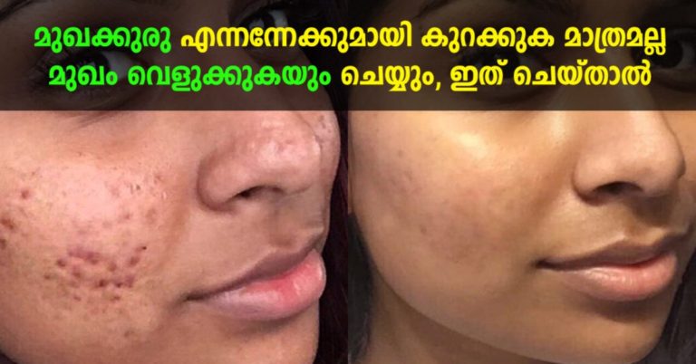 Pimples remedy