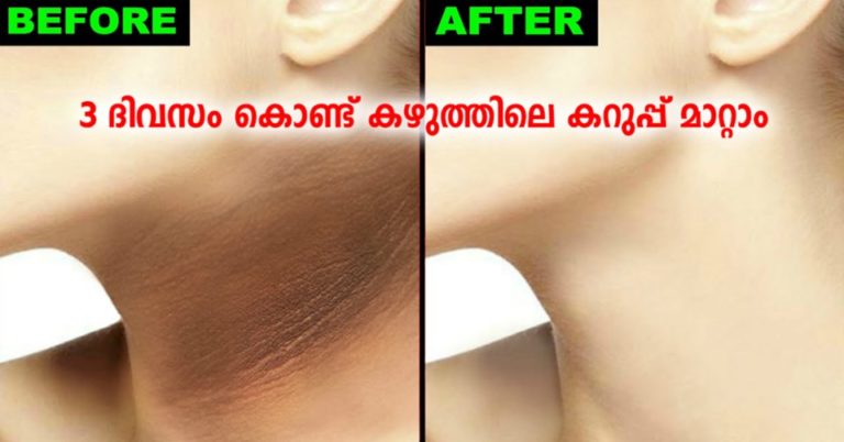 Home Remedies For A Dark Neck: Make Your Skin Tone Even!