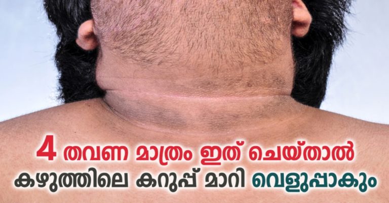 Home Remedies For A Dark Neck: Make Your Skin Tone Even!