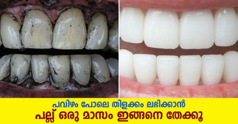 Top 5 Teeth Whitening Home Remedies